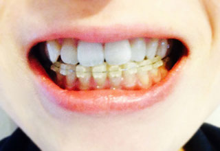 歯列矯正中、歯並び　あごのゆがみ
