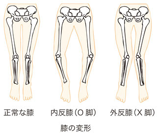 変形性膝関節症でひざ痛が続く原因