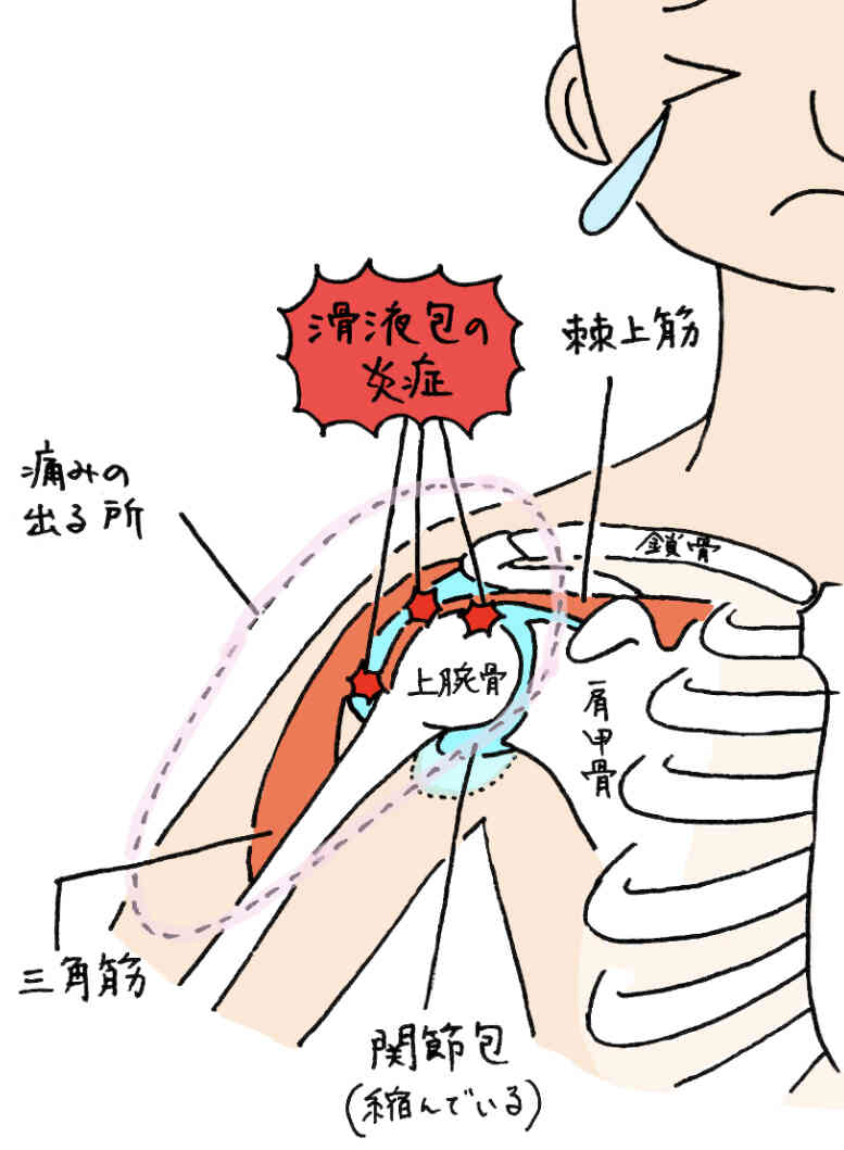 高崎市の腰痛整体　五十肩・腕があがらない痛み、肩関節周囲炎（五十肩）とは
